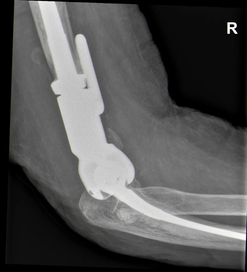 Artificial elbow joint