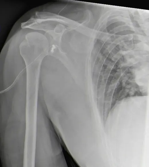 A shoulder dislocation is shown.
