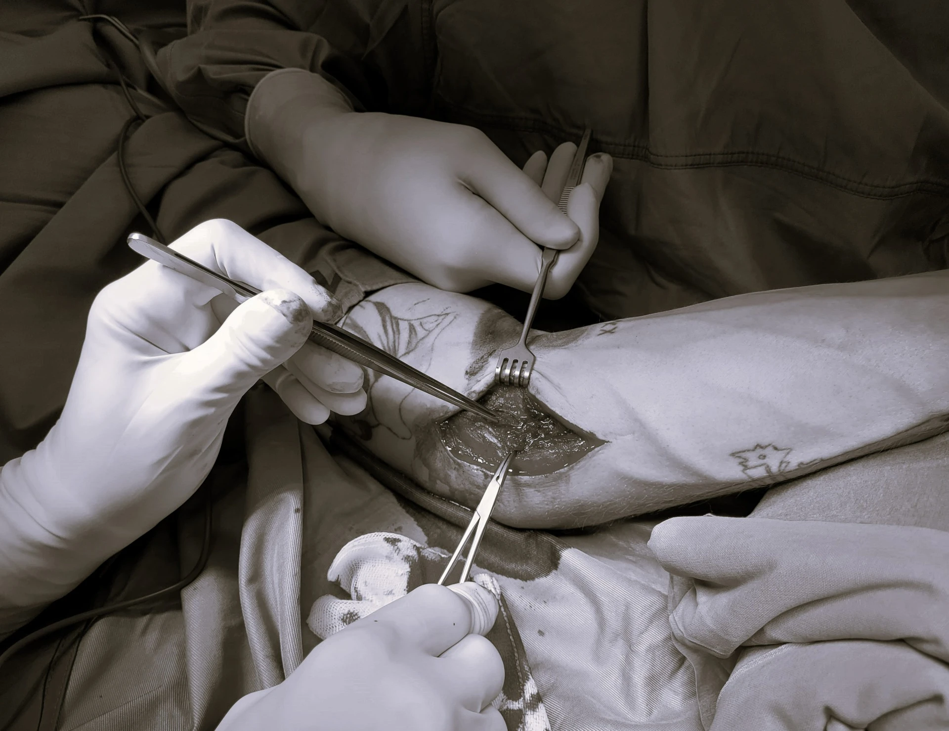 Eine Operation bei einem Werferellenbogen ist abgebildet.